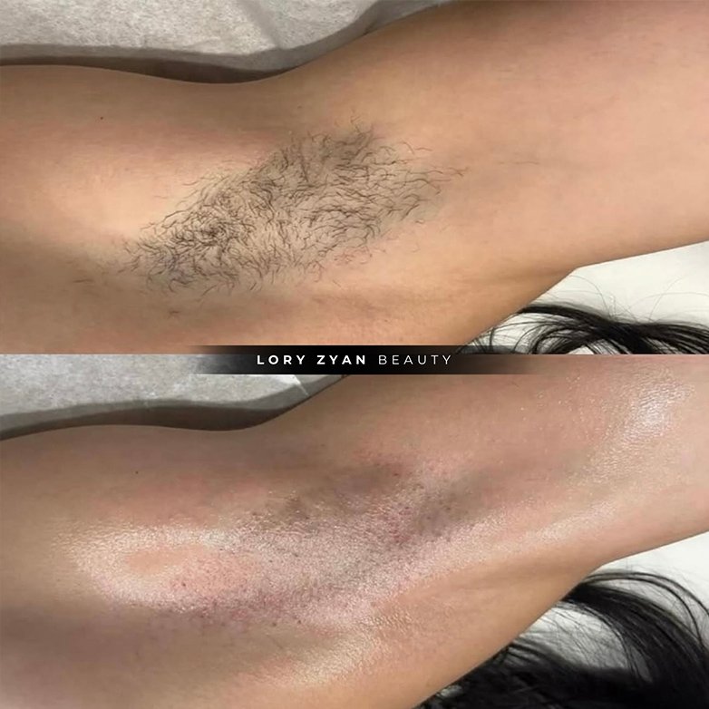 laser-hair-removal-005